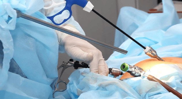 Cirugía Laparoscópica para diastasis de rectos en CDMX y Edo. Mex