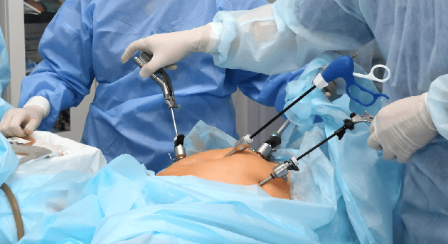 Restitución del tránsito intestinal en CDMX y Edo. Mex: Cirugía General especializada